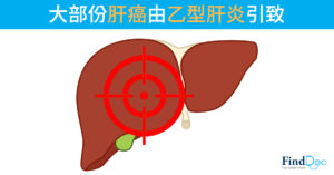 大部份肝癌由乙型肝炎引致