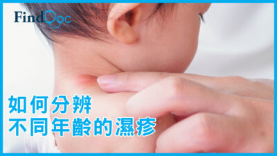 何時才是治療濕疹黃金時間?